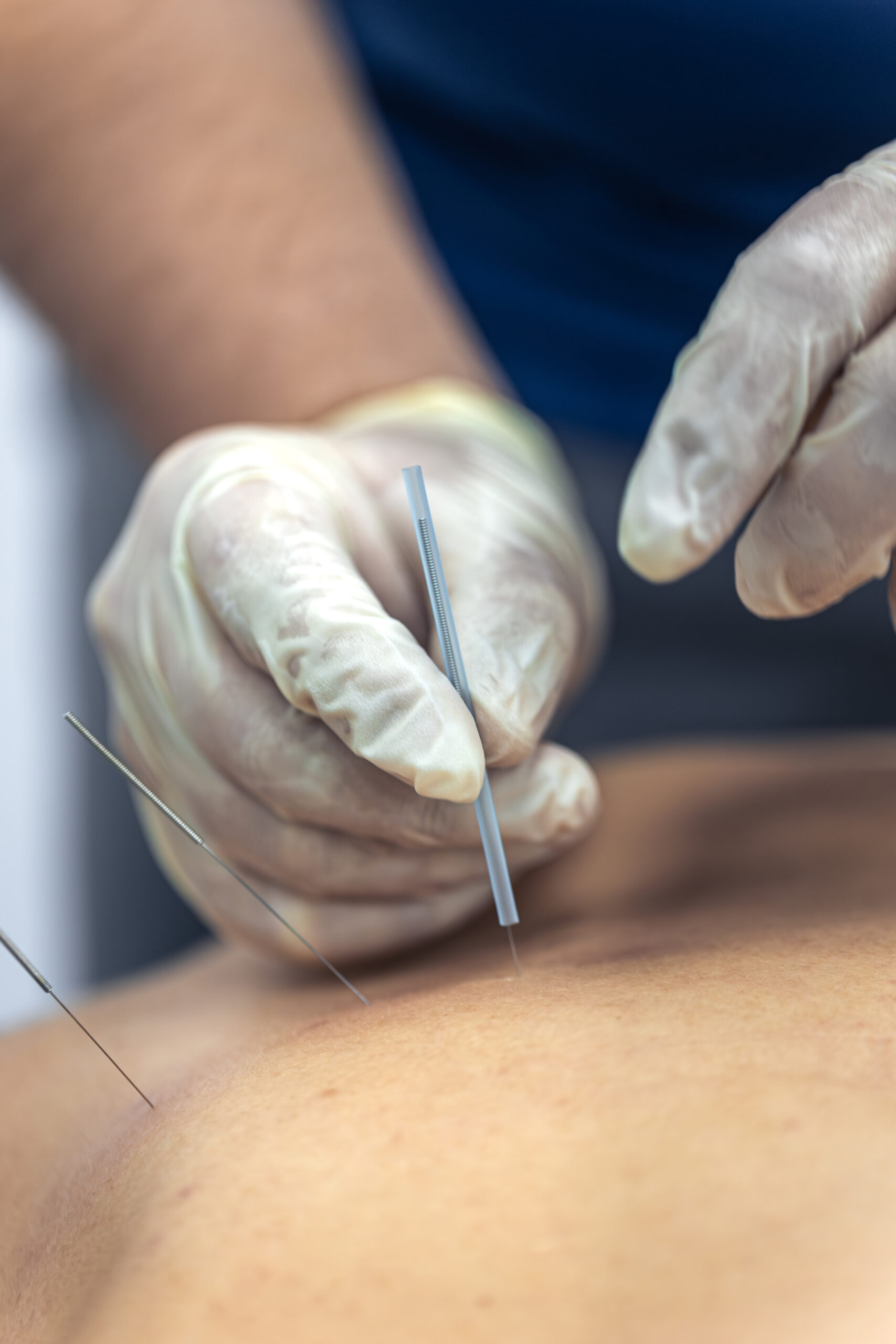 Practitioner inserting acupuncture needles into a patient’s back during treatment